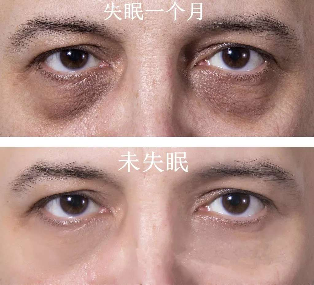 障碍睡眠亚健康的表现_亚健康睡眠障碍_障碍睡眠亚健康的原因
